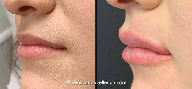 juvederm volbella lip augmentation before after photos by dr. Hanna and Dr. Jack, La Nouvelle Medical Spa, Oxnard, Ventura county  