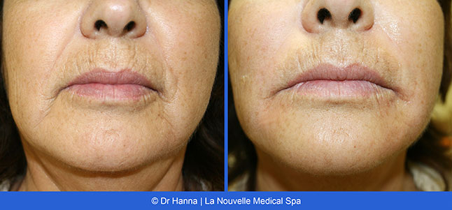 radiesse, juvederm, restylane, voluma before after photos by dr. Hanna, La Nouvelle Medical Spa, Oxnard, Ventura county  