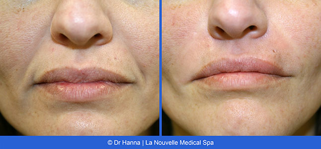 radiesse, juvederm, restylane, voluma before after photos by dr. Hanna, La Nouvelle Medical Spa, Oxnard, Ventura county  