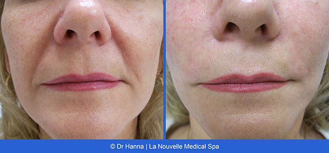 radiesse, juvederm, restylane, voluma before after photos by dr. Hanna, La Nouvelle Medical Spa, Oxnard, Ventura county  