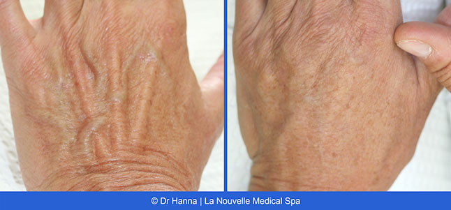radiesse, juvederm, restylane, voluma before after photos by dr. Hanna, La Nouvelle Medical Spa, Oxnard, Ventura county  